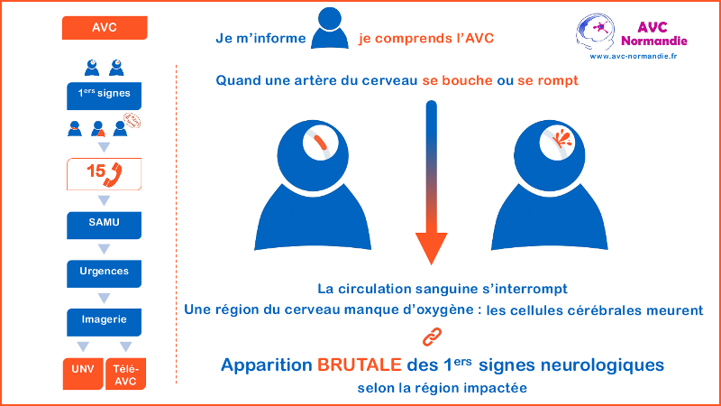 Qu'est-ce qu'un AVC ?